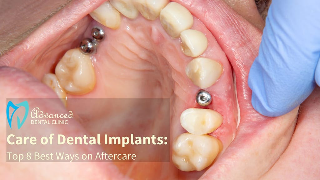 Top 8 Effective ways to take care of Dental Implants