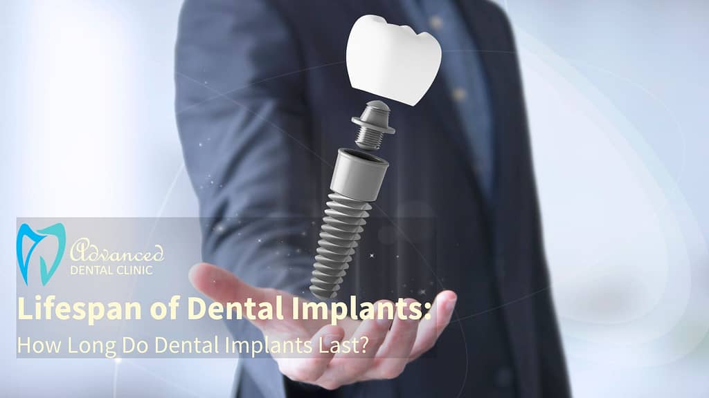 How Long Does Dental Implants Last?