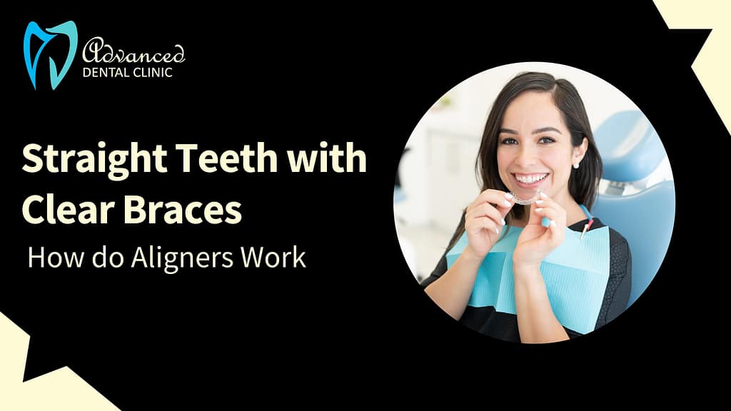 Straight Teeth with Clear Braces: How do Aligners Work