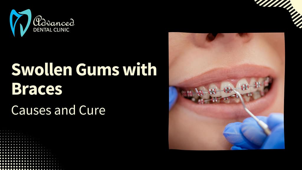 Swollen Gums with Braces: Causes and Cure
