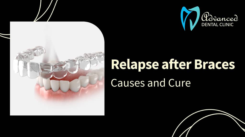 Orthodontic Relapse after Braces: Causes and Cure