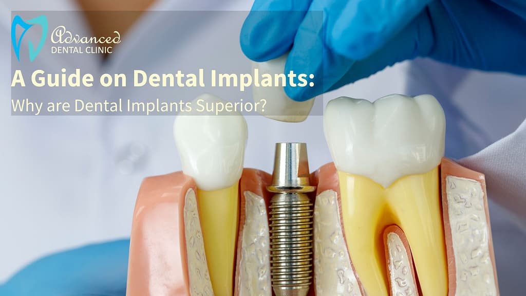 A Brief Guide for Dental Implant Treatment: A Basic Patient Guide
