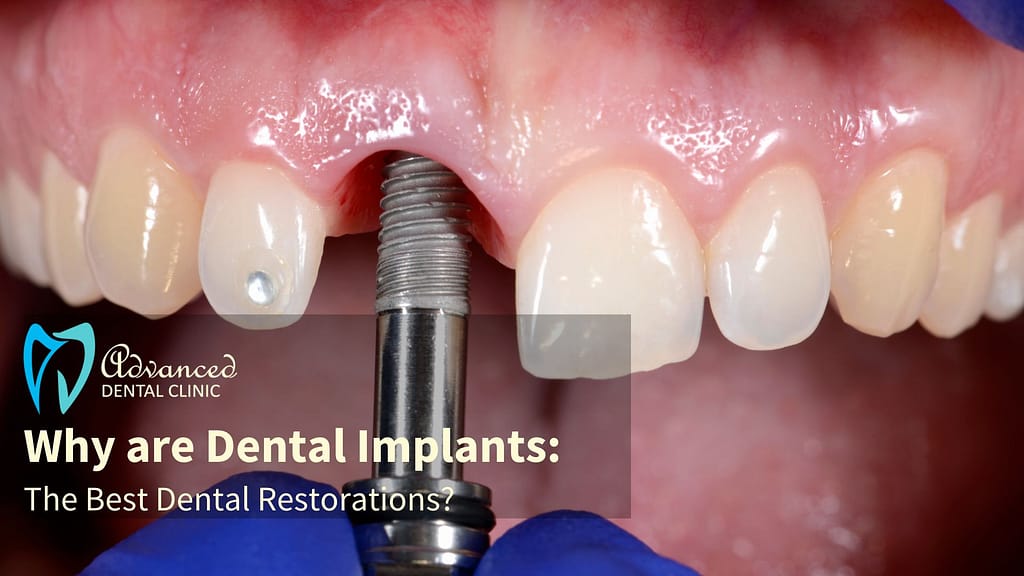 Dental implants: The best dental restorations