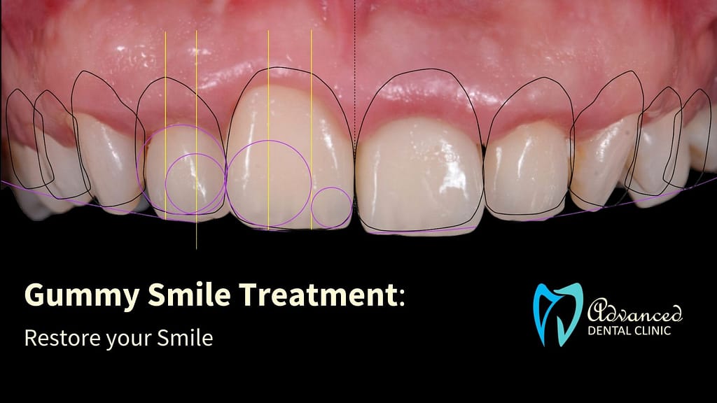 How Gummy Smile Treatment & Surgery Can Restore Your Smile