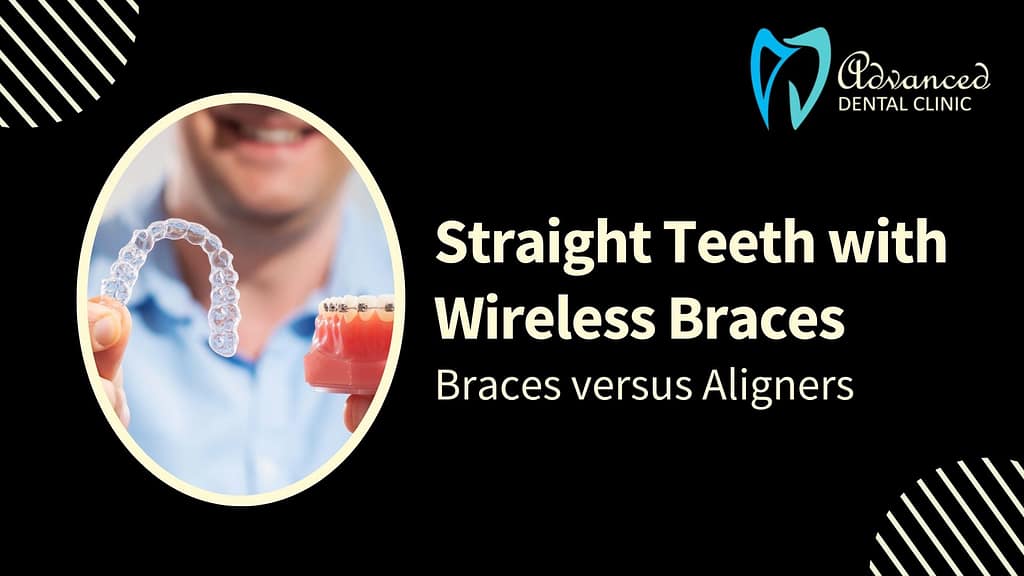 Braces versus Aligners: Get Straight Teeth with Wireless Braces