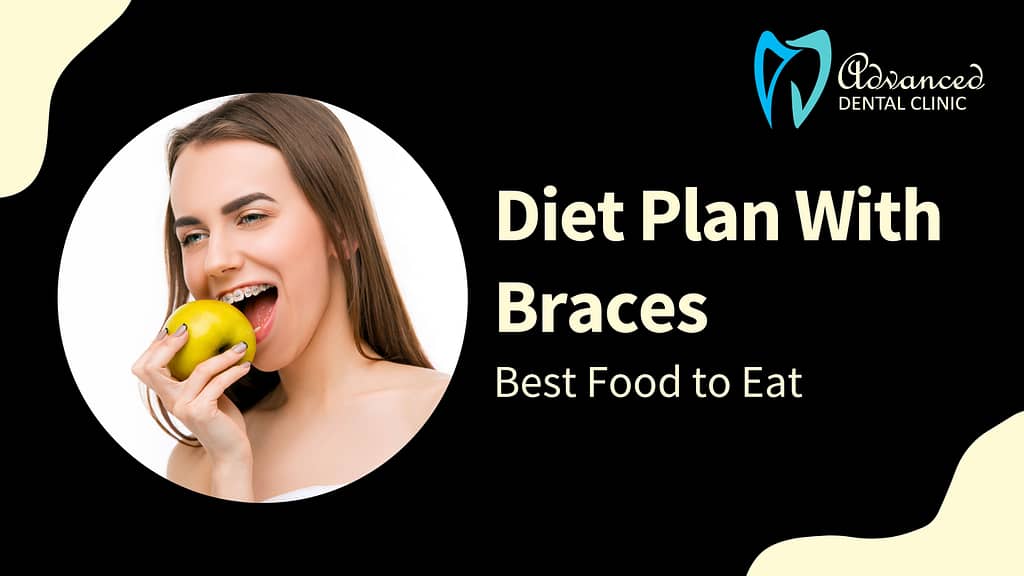 Best Diet Plan with Braces: Best Food to Eat