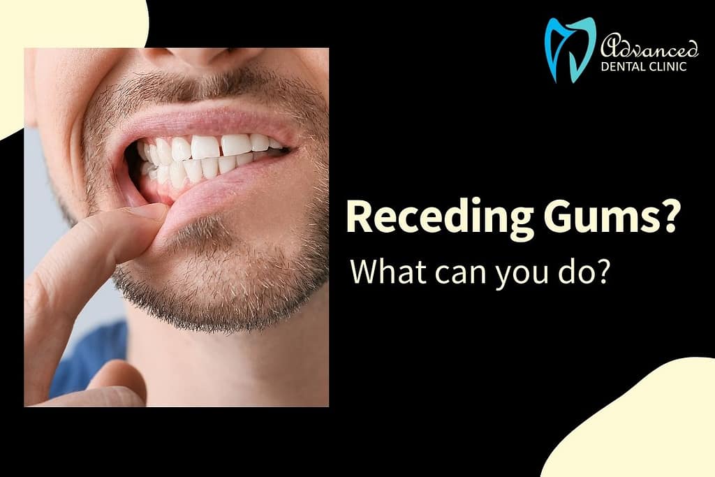 Gum Recession: Cause, Instant Cure and Treatment