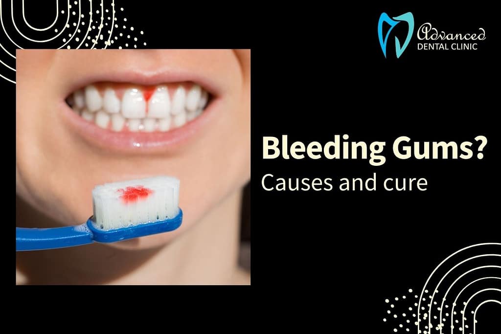 Cause, Cure and Best Treatment for Bleeding Gums