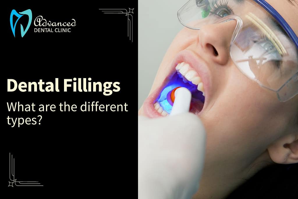 Dental fillings – A brief about types of dental fillings