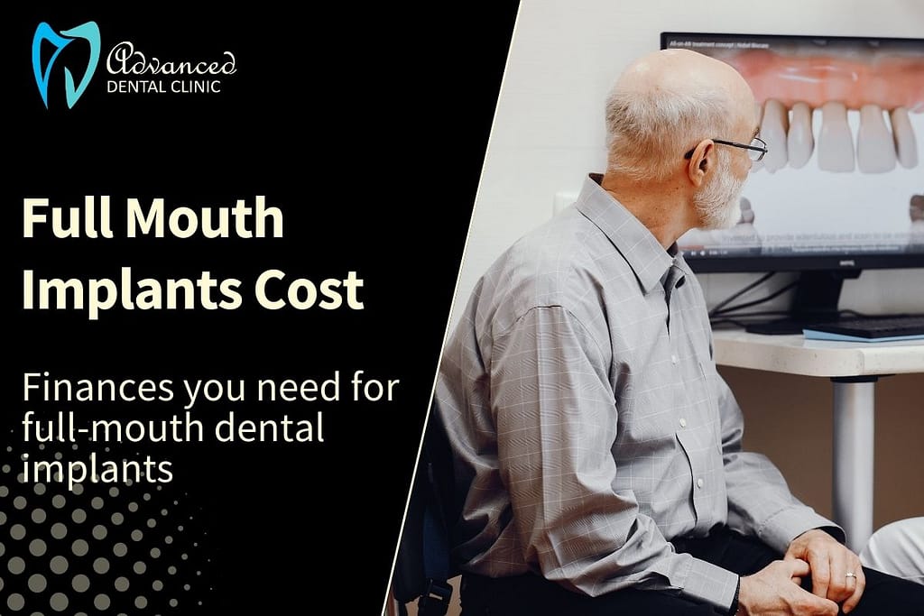 Budget required for full mouth Implants