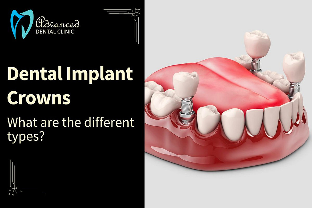 Dental Implant Crowns – Different Types