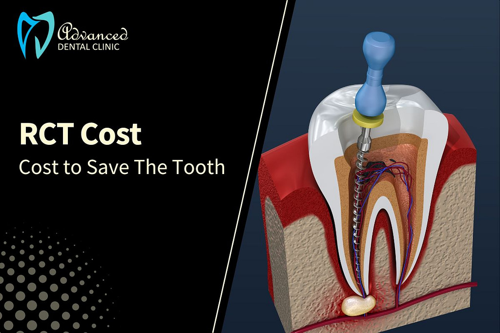 Cost to save your Tooth