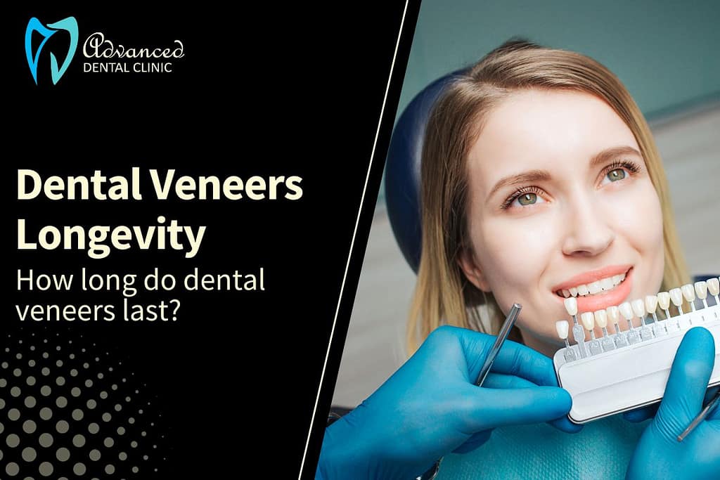 Longevity of Veneers: How Long Do They Last?