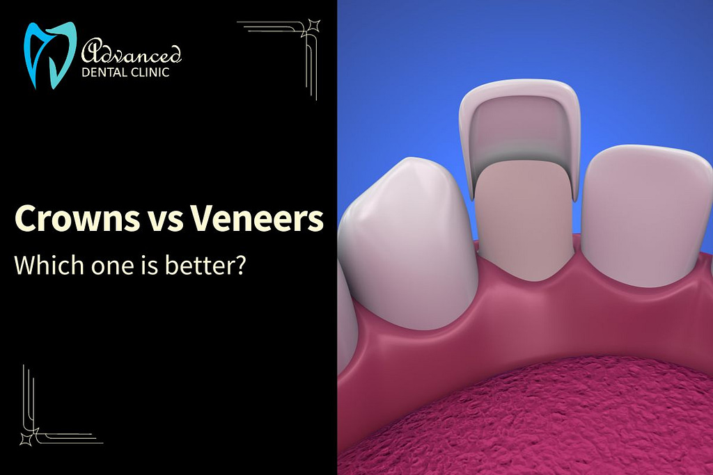 Are crowns or veneers better for front teeth