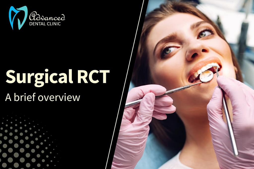 What is root canal surgery