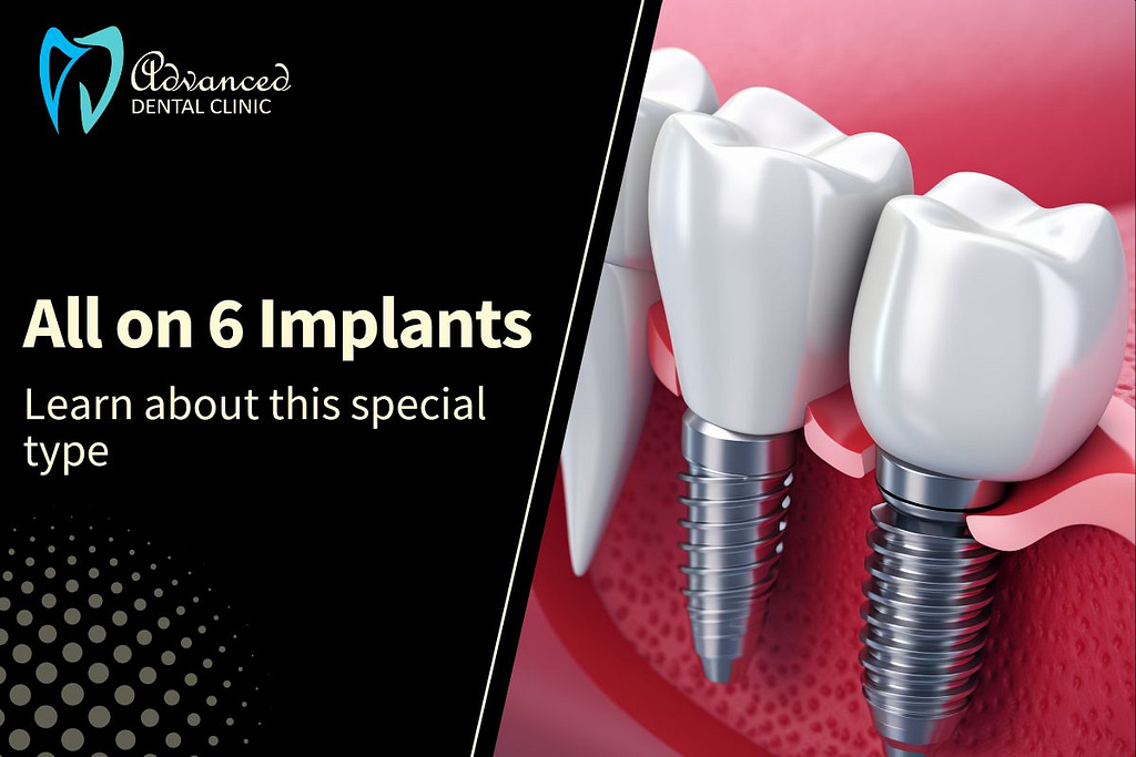 All on 6 Dental Implants in Delhi