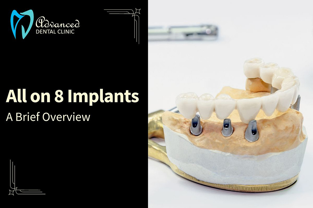 All on 8 Dental Implants in Delhi