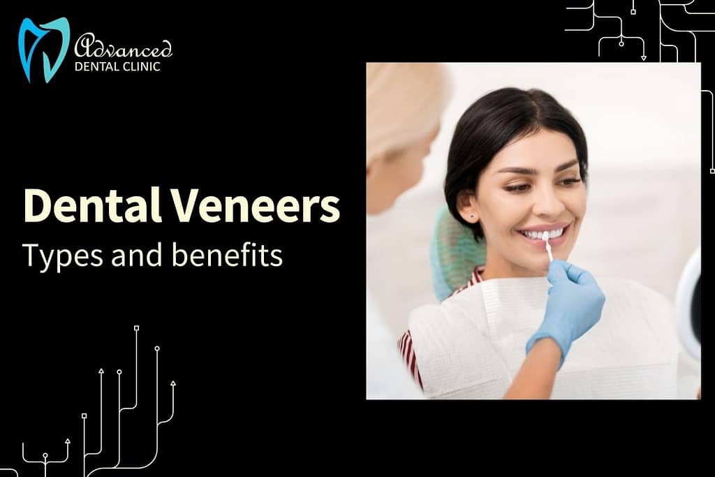 Dental Veneers Types and Application for Smile Correction