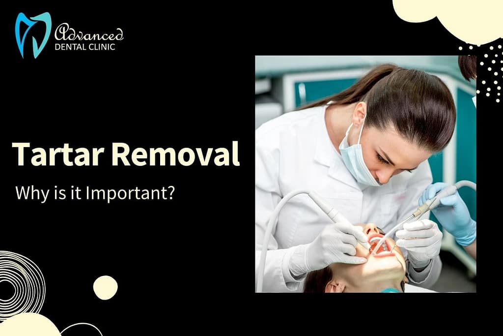 A brief about Tartar: What it is and it’s Removal