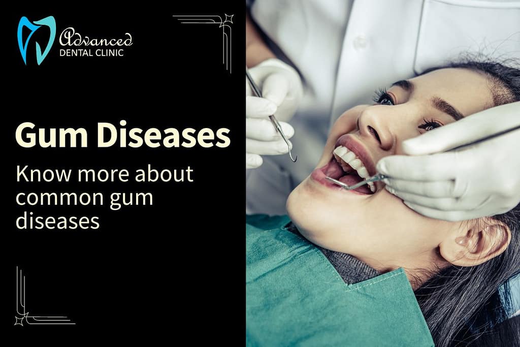 Understanding Common Gums Diseases