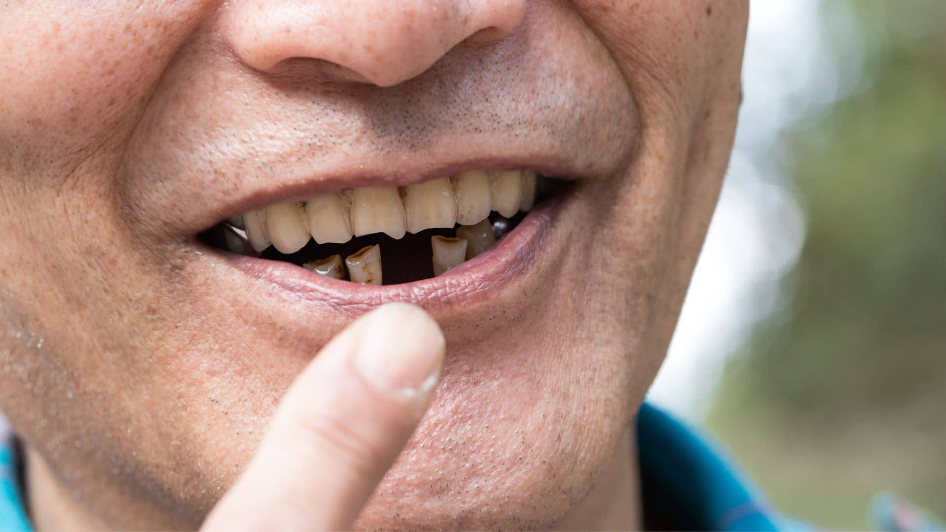 Old man with a missing teeth and his intention to get Missing Teeth Treatment East Delhi