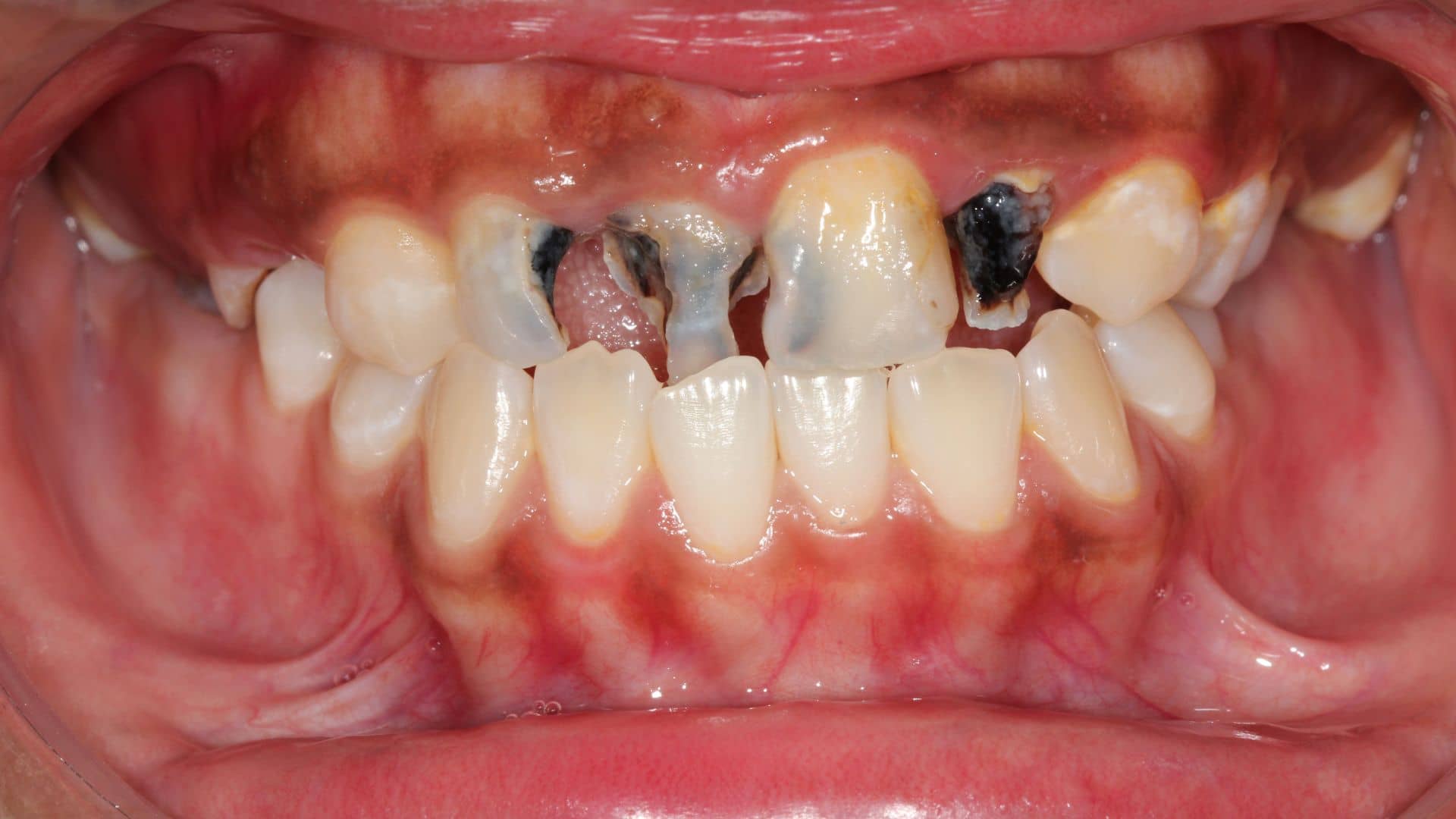 Tooth Decay Treatment Delhi