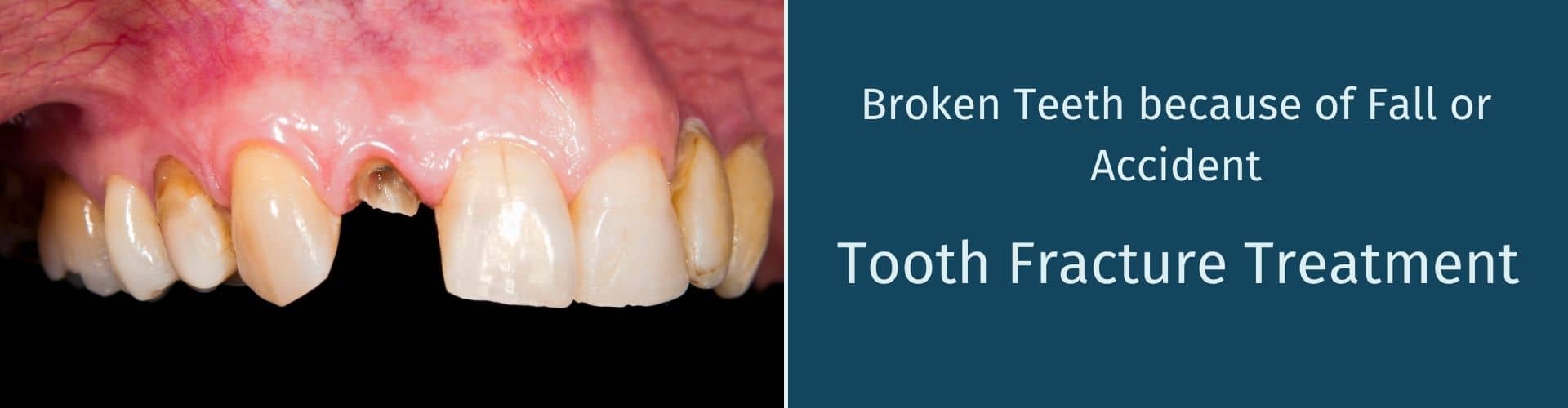 Tooth Fracture Treatment Delhi