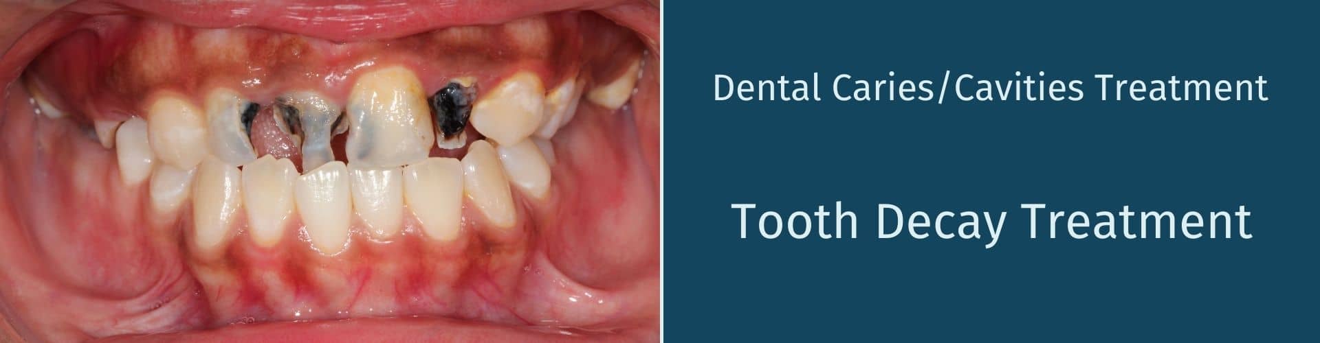 Tooth Decay Treatment East Delhi