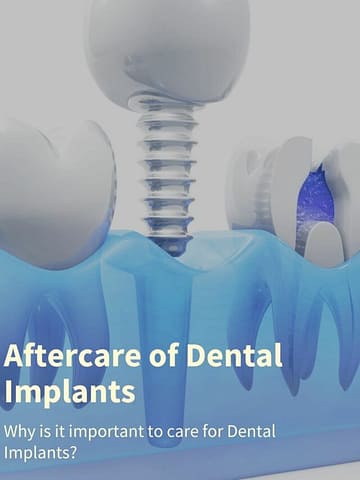 How to take care of Dental Implants at Home – Advanced Dental Clinic East Delhi