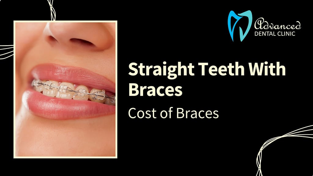 Straight Teeth With Braces: Dental Braces Cost in East Delhi