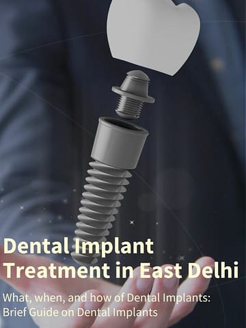 Hasslefree Dental Implants Treatment in One Day – Dentist Delhi